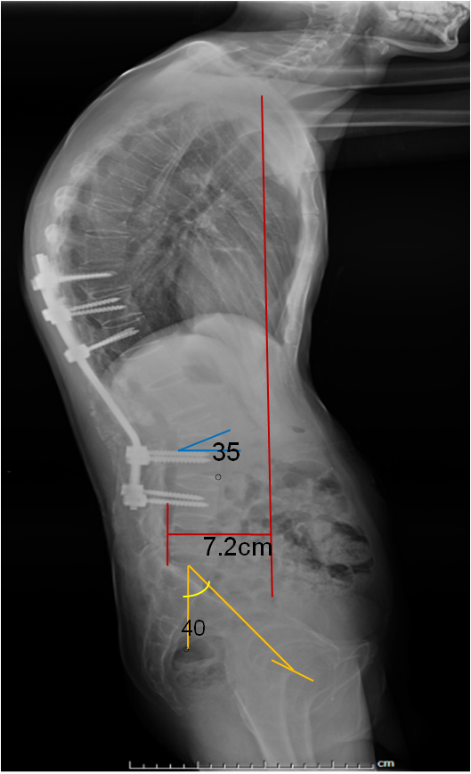 强直性脊柱炎后凸矫形病例2例