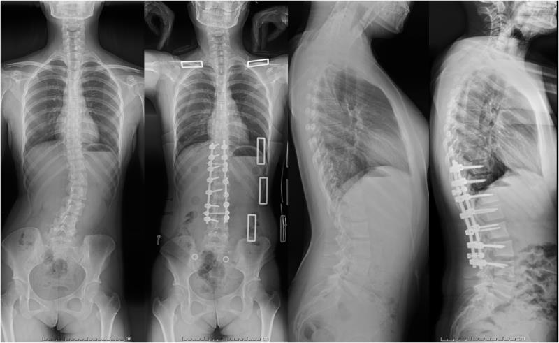 青少年特发性脊柱侧凸矫形1例 - 典型病例 - 青岛市中心医院脊柱外科